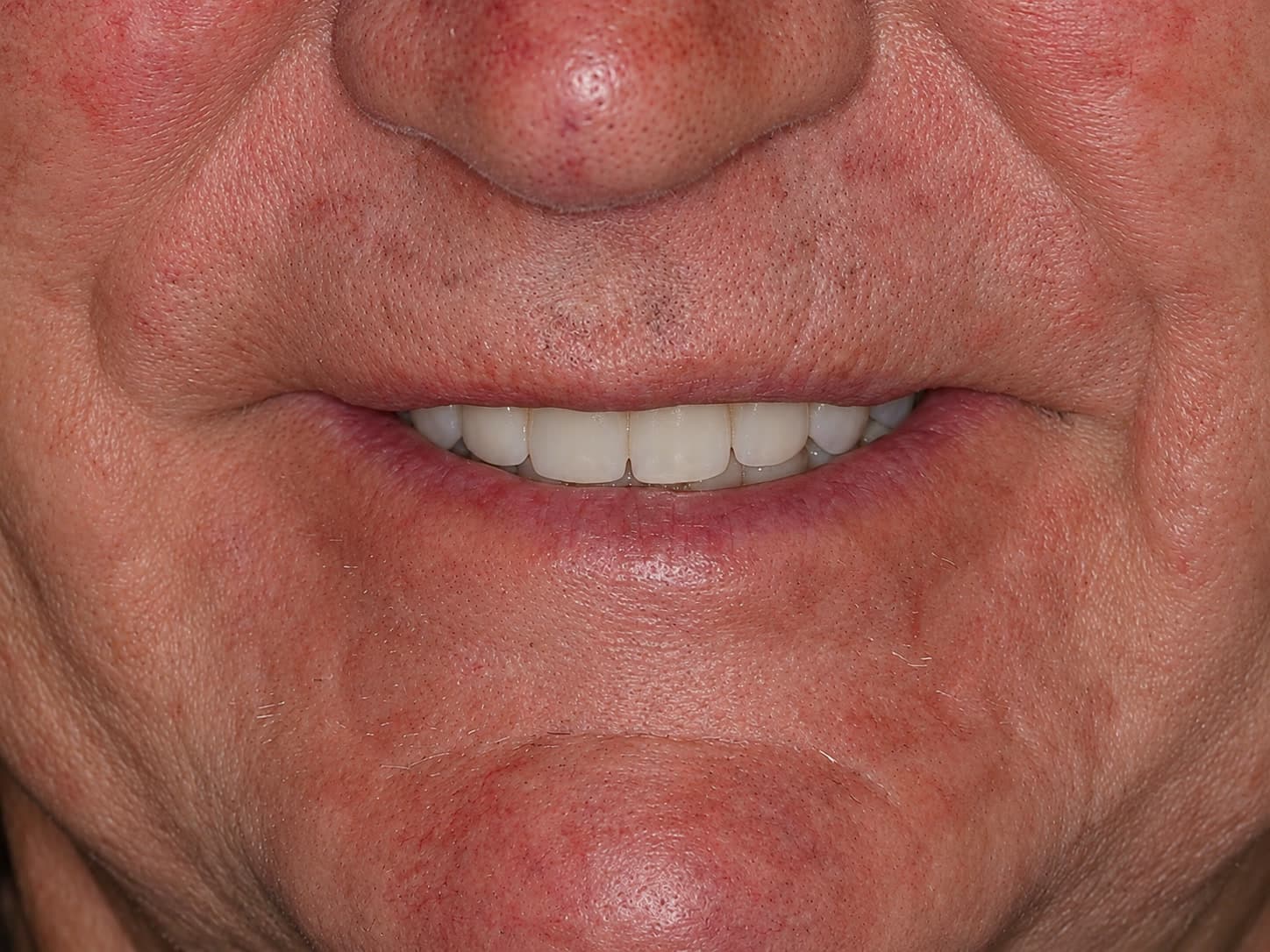 Patient after full mouth rehabilitation