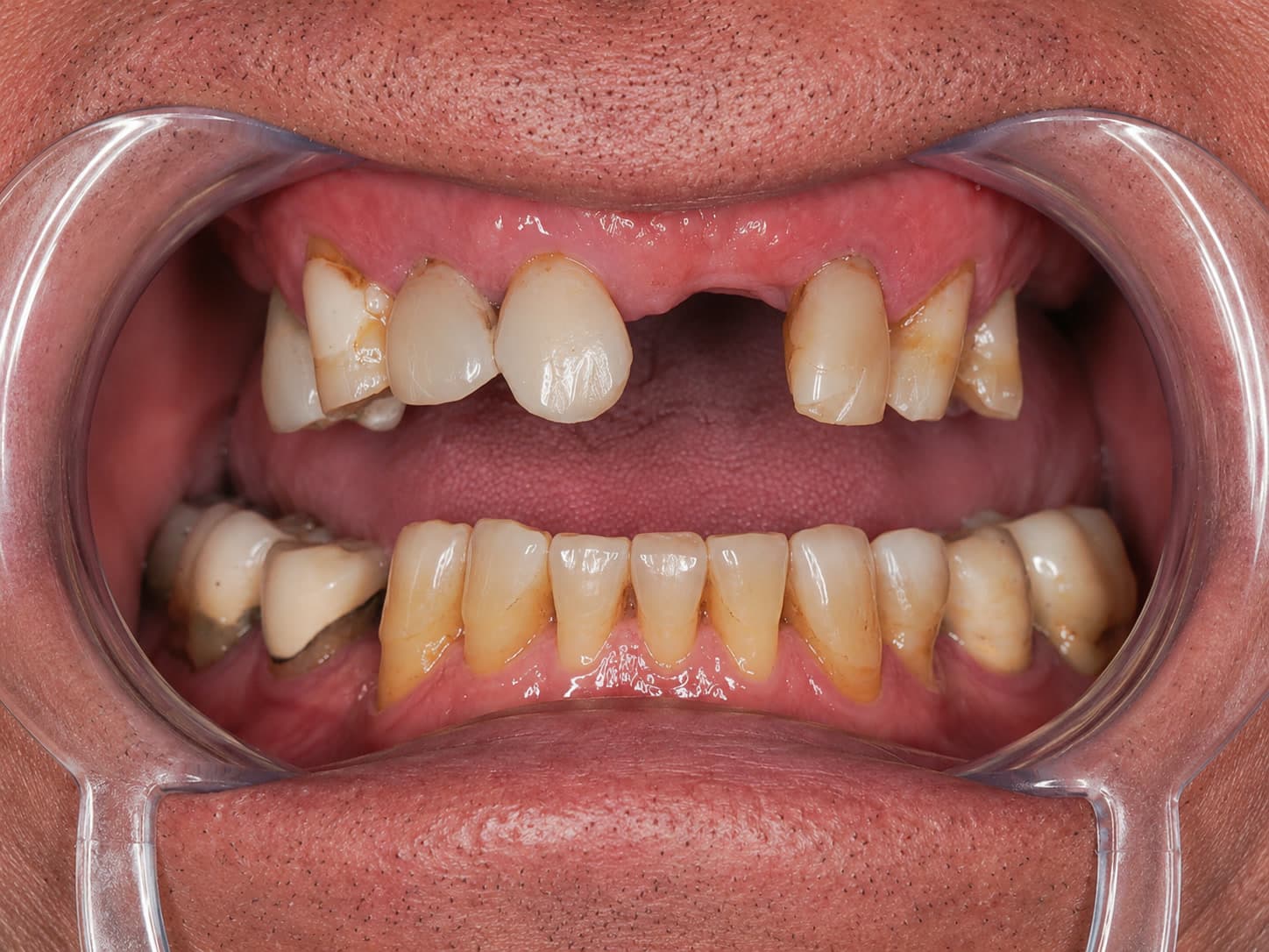 Retracted view of teeth before full mouth rehabilitation